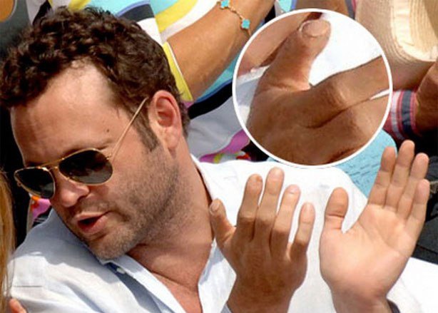 Актер Винс Вон потерял кончик большого пальца правой руки в автокатастрофе, когда ему было 17 лет. Актер Винс Вон потерял кончик большого пальца правой руки в автокатастрофе, когда ему было 17 лет.