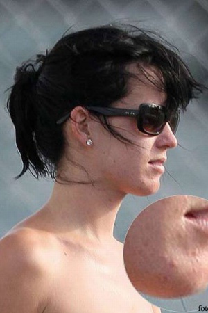 Кэти Перри. Дефект внешности: проблемная кожа