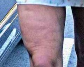 Бритни Спирс сделала липосакцию (ФОТОРЕПОРТАЖ)