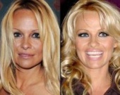 Губы: искусственные прелести знаменитостей