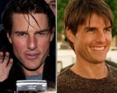 Том Круз колет ботокс